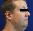  Bandingkan Sebelum & Sesudah Foto Neck Lift