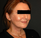  Bandingkan Sebelum & Sesudah Foto Neck Lift