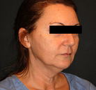  Bandingkan Sebelum & Sesudah Foto Neck Lift