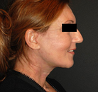  Bandingkan Sebelum & Sesudah Foto Neck Lift