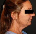  Bandingkan Sebelum & Sesudah Foto Neck Lift