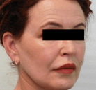  Bandingkan Sebelum & Sesudah Foto Neck Lift