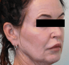  Bandingkan Sebelum & Sesudah Foto Neck Lift