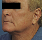  Bandingkan Sebelum & Sesudah Foto Neck Lift