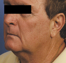  Bandingkan Sebelum & Sesudah Foto Neck Lift