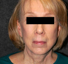  Bandingkan Sebelum & Sesudah Foto Neck Lift