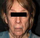  Bandingkan Sebelum & Sesudah Foto Neck Lift