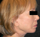  Bandingkan Sebelum & Sesudah Foto Neck Lift