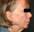  Bandingkan Sebelum & Sesudah Foto Neck Lift