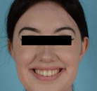  Bandingkan Sebelum & Sesudah Foto Augmentasi Dagu