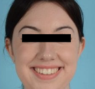  Bandingkan Sebelum & Sesudah Foto Augmentasi Dagu