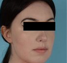  Bandingkan Sebelum & Sesudah Foto Augmentasi Dagu