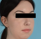  Bandingkan Sebelum & Sesudah Foto Augmentasi Dagu