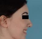  Bandingkan Sebelum & Sesudah Foto Augmentasi Dagu