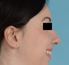  Bandingkan Sebelum & Sesudah Foto Augmentasi Dagu