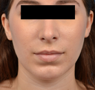  Bandingkan Sebelum & Sesudah Foto Augmentasi Dagu