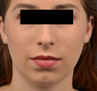  Bandingkan Sebelum & Sesudah Foto Augmentasi Dagu