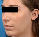  Bandingkan Sebelum & Sesudah Foto Augmentasi Dagu