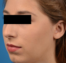  Bandingkan Sebelum & Sesudah Foto Augmentasi Dagu