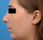  Bandingkan Sebelum & Sesudah Foto Augmentasi Dagu