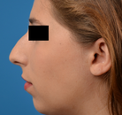  Bandingkan Sebelum & Sesudah Foto Augmentasi Dagu