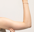  Bandingkan Sebelum & Sesudah Foto Arm Lift