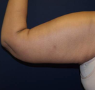  Bandingkan Sebelum & Sesudah Foto Arm Lift