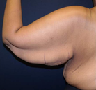  Bandingkan Sebelum & Sesudah Foto Arm Lift