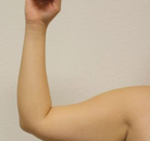  Bandingkan Sebelum & Sesudah Foto Arm Lift