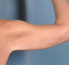  Bandingkan Sebelum & Sesudah Foto Arm Lift