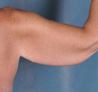  Bandingkan Sebelum & Sesudah Foto Arm Lift