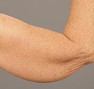  Bandingkan Sebelum & Sesudah Foto Arm Lift