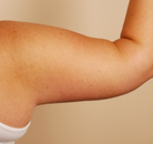  Bandingkan Sebelum & Sesudah Foto Arm Lift