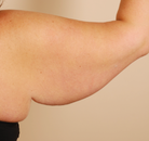  Bandingkan Sebelum & Sesudah Foto Arm Lift