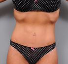 Bandingkan Sebelum & Sesudah Foto Body Lift