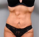 Bandingkan Sebelum & Sesudah Foto Body Lift