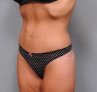 Bandingkan Sebelum & Sesudah Foto Body Lift