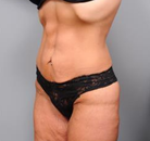 Bandingkan Sebelum & Sesudah Foto Body Lift