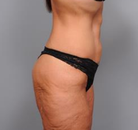 Bandingkan Sebelum & Sesudah Foto Body Lift