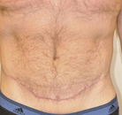 Bandingkan Sebelum & Sesudah Foto Body Lift