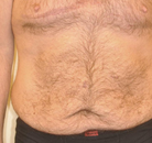 Bandingkan Sebelum & Sesudah Foto Body Lift