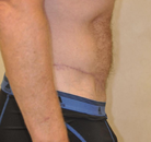 Bandingkan Sebelum & Sesudah Foto Body Lift