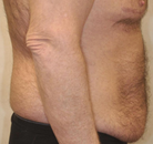 Bandingkan Sebelum & Sesudah Foto Body Lift