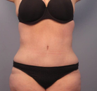 Bandingkan Sebelum & Sesudah Foto Body Lift