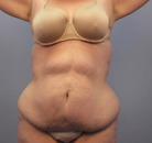 Bandingkan Sebelum & Sesudah Foto Body Lift