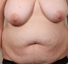  Bandingkan Sebelum & Sesudah Foto Breast Lift