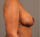  Bandingkan Sebelum & Sesudah Foto Breast Lift