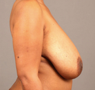  Bandingkan Sebelum & Sesudah Foto Breast Lift