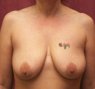  Bandingkan Sebelum & Sesudah Foto Breast Lift