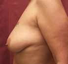  Bandingkan Sebelum & Sesudah Foto Breast Lift